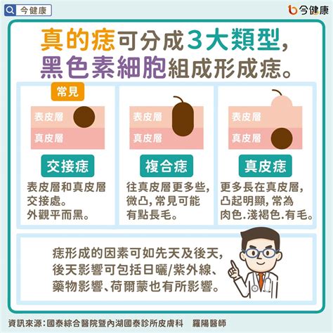 身體有痣|痣是什麼？一次了解痣原因、就醫時機以及如何改善